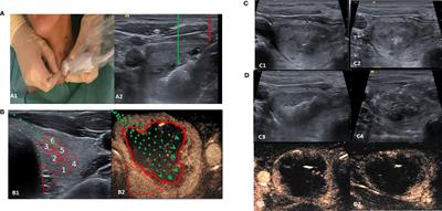 Long-Term Follow-Up of Single-Fiber Multiple Low-Intensity Energy Laser Ablation Technique of Benign Thyroid Nodules